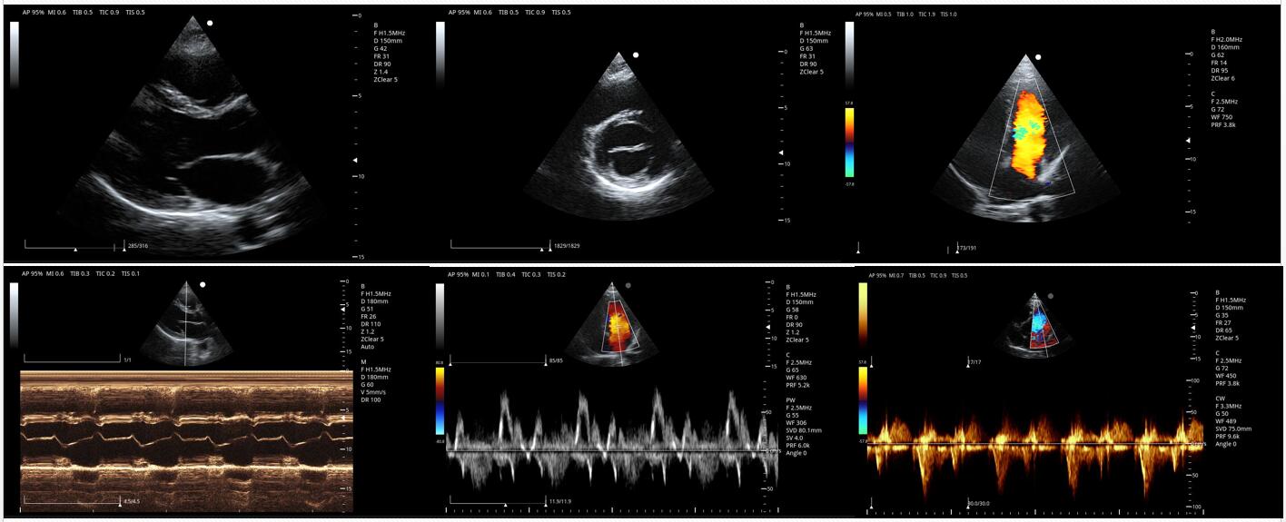 颜色多普勒结果