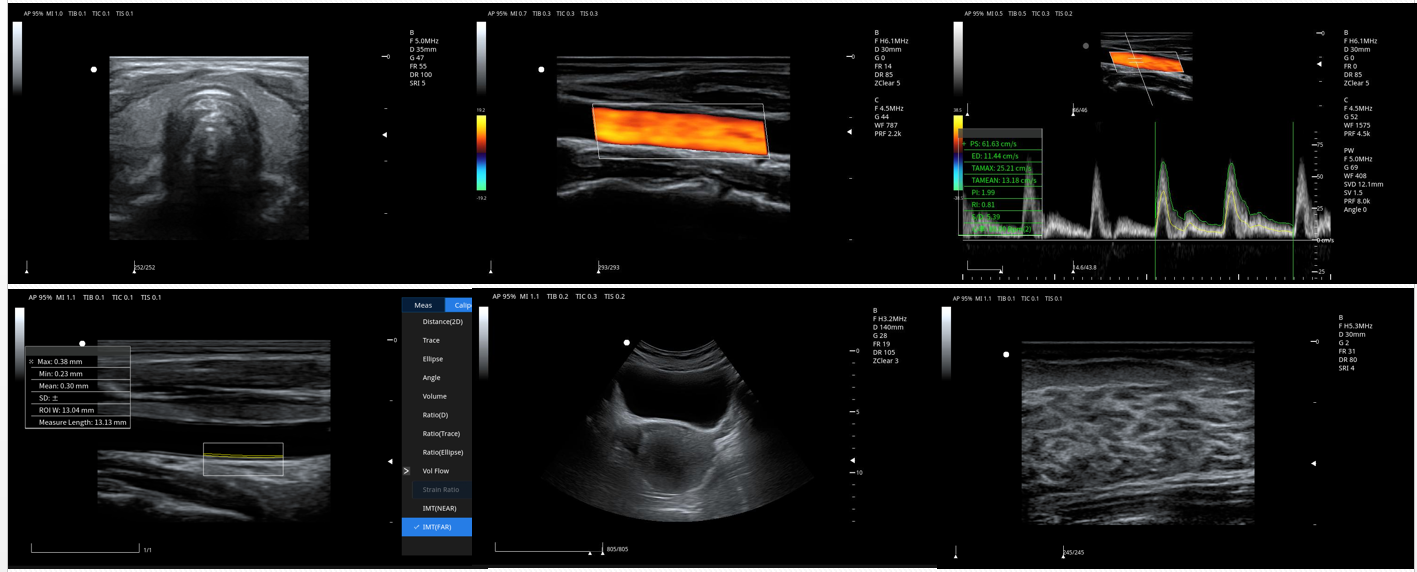 彩色多普勒图片